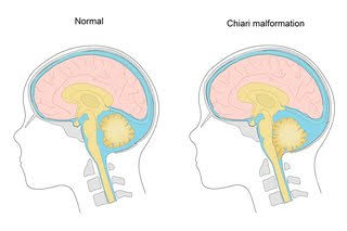 Do you know what is Arnold-Chiari syndrome