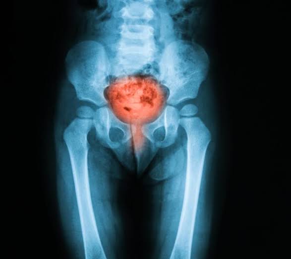 Do you know what is Painful Bladder Syndrome