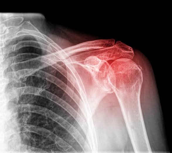 Do you know what is Shoulder collision syndrome?