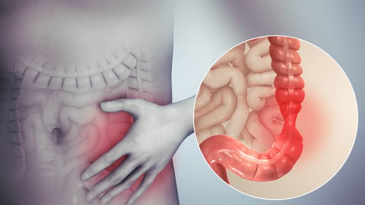Do you know what is Irritable bowel syndrome