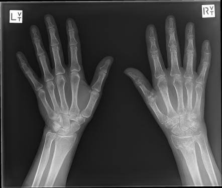Do you know what is Complex regional pain syndrome