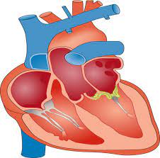 Do you know what is Subacute bacterial endocarditis